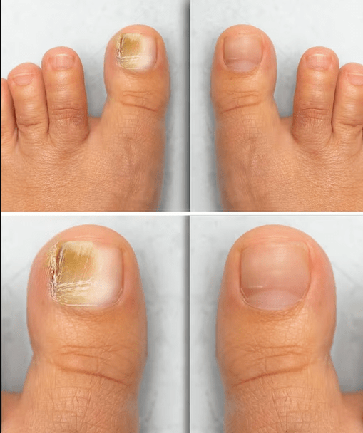 Fungus foot - before and after treatment with merged cream