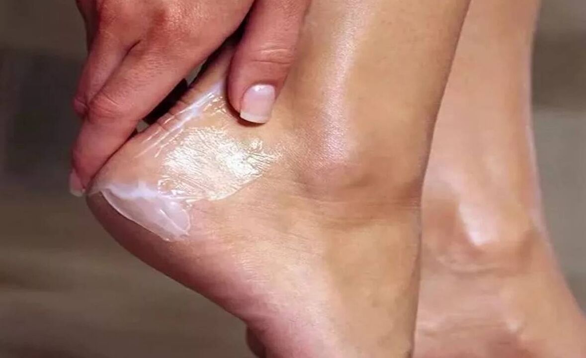 How to treat mushrooms on foot with fungal cream
