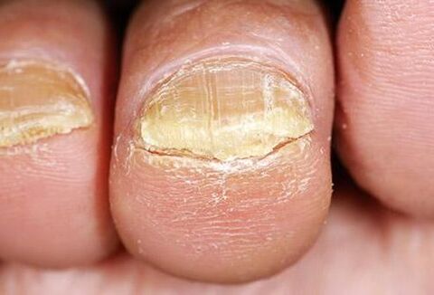 symptoms of toenail fungus