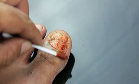 Lesion treatment with fungus