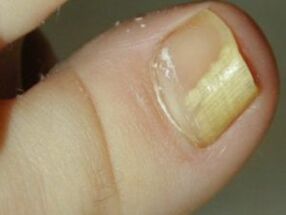 Nails that hurt