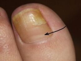 How to recognize the presence of nail fungus in the leg thumbs