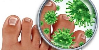 How to treat a fungal infection in the finger