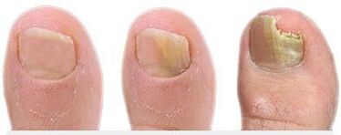 Stage of fungal development on nails