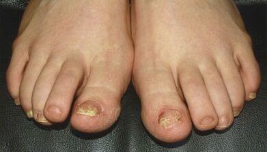 The signs and symptoms of fungus on the nails