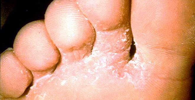 Skin fungal wounds between the toes