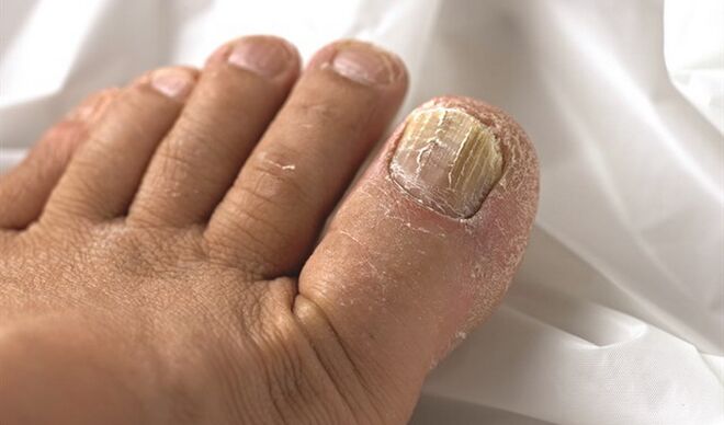 Spread mycose wounds to nail plate