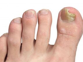 The yellow spots on the nails of the foot of the fungus