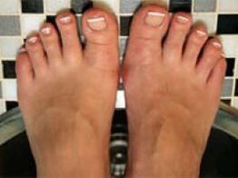 fungus on nails and feet