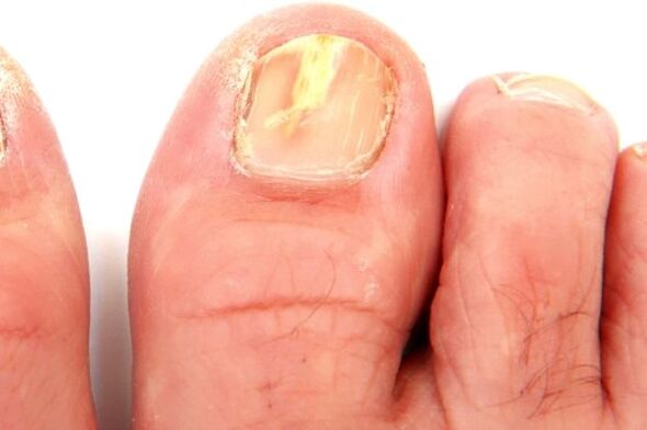 damage to the nail plate due to fungal infection