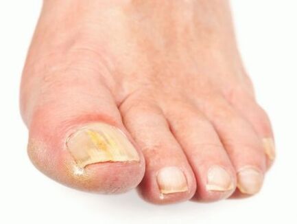 nail fungus damage