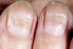 nail fungus symptoms