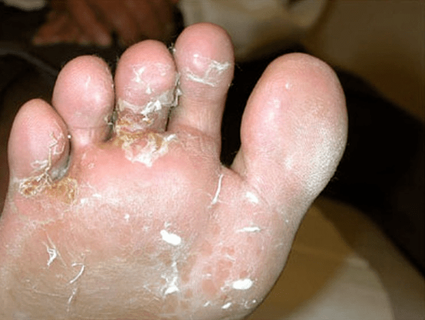 fungal growth on the toes