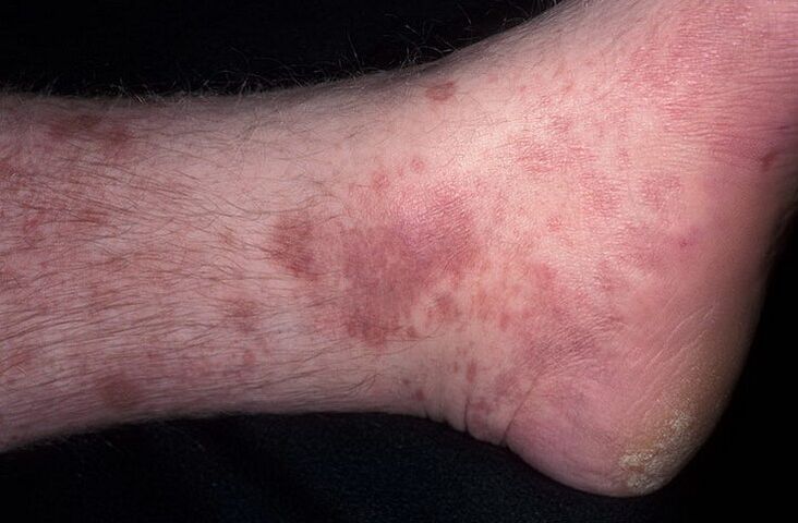 mycotic eczema on the feet