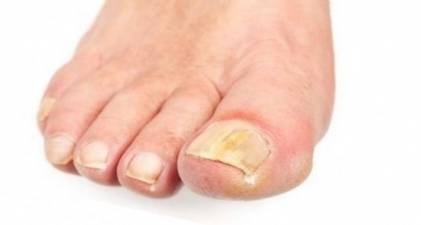 nail yellowing due to fungus