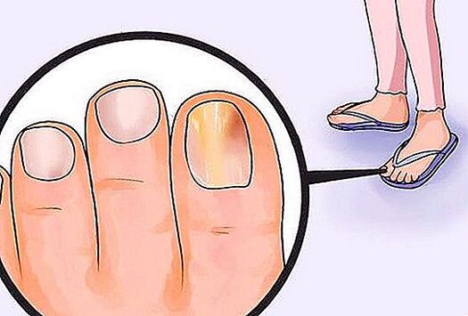 toenail fungus