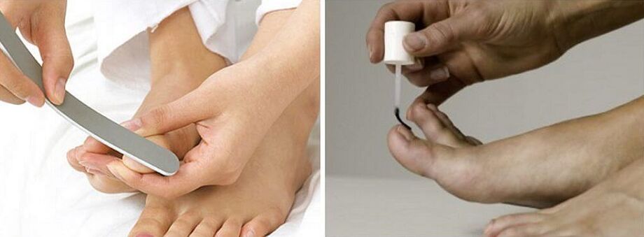 nail fungus treatment with varnish